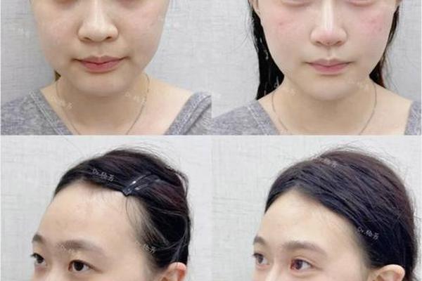 圆脸怎么变成v脸,圆脸变v脸要做哪些整形项目